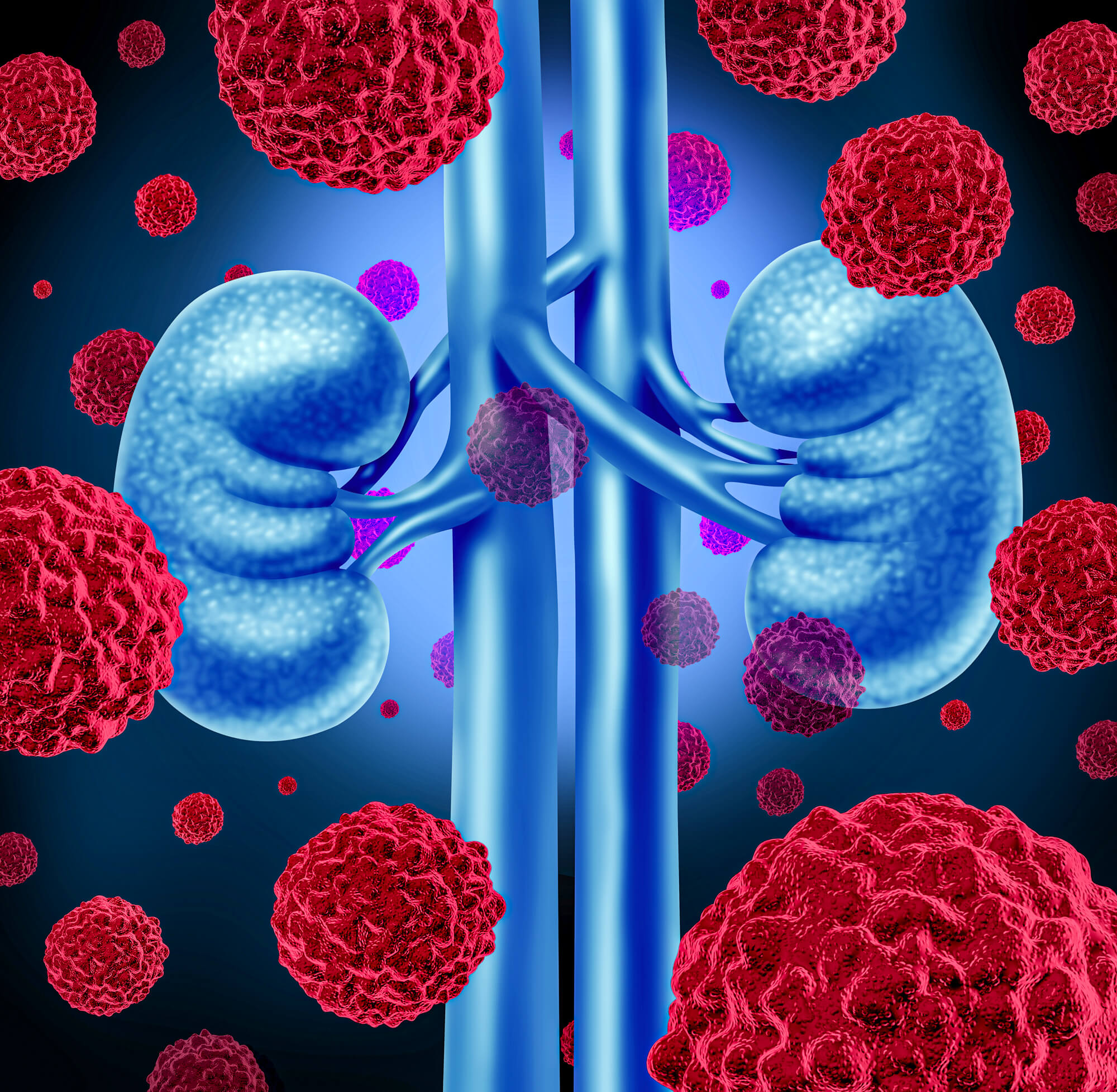 Factores de riesgo del cáncer de riñón