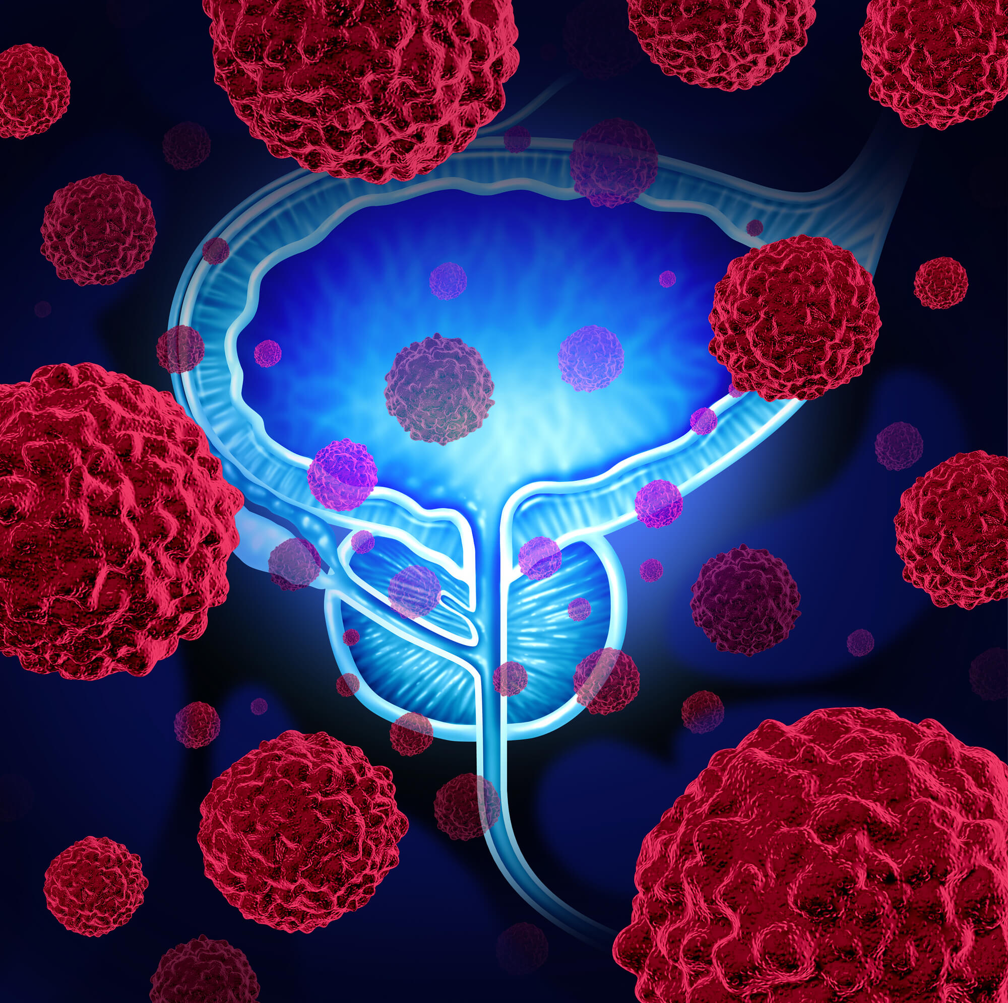 Cáncer de Próstata y la importancia de la detección oportuna